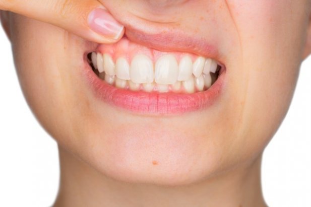How Gum Contouring Can Transform Your Smile: A Step-by-Step Explanation Article - ArticleTed -  News and Articles